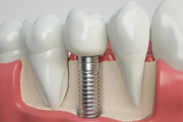 DCS Dentale Manufaktur in Hamburg-Wandsbek Fester Zahnersatz